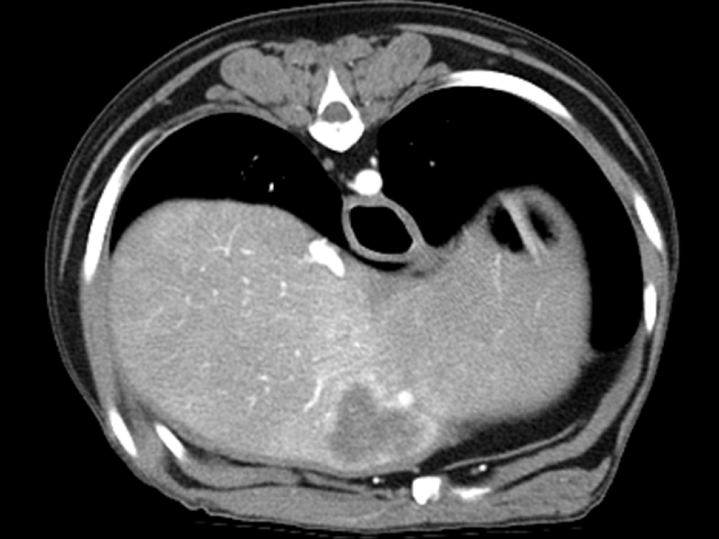 Late arterial phase